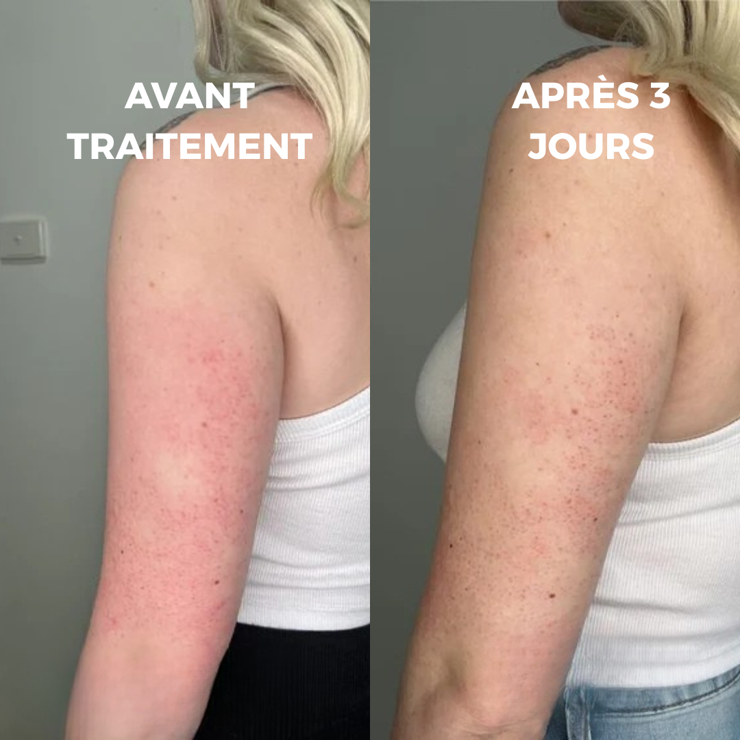 Peau lisse et douce dès les premières applications – Curvea Triple Acide - Cure 1 mois