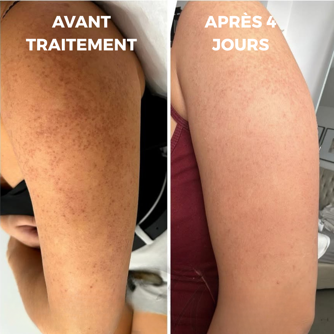 Peau lisse et douce dès les premières applications – Curvea Triple Acide - Cure 1 mois
