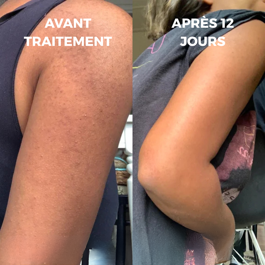 Peau lisse et douce dès les premières applications – Curvea Triple Acide - Cure 1 mois